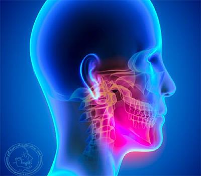  درد های صورتی-دهانی که ناشی از سردرد می باشند